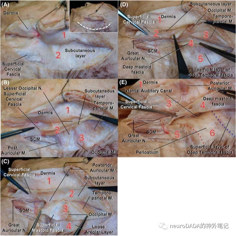 1,皮膚2,皮下組織3,乳突淺筋膜——對應smas層,與顳頂筋膜(顳淺筋膜)