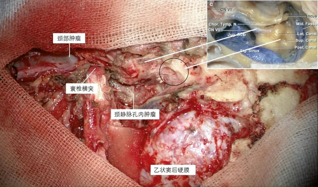 顱頸聯合 經乳突經頸靜脈突入路在傳統增強mri (t1 c) 導航數據的基礎