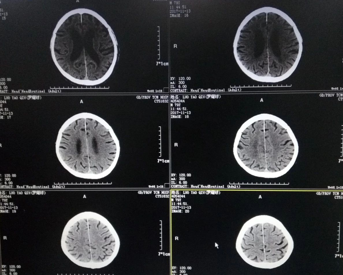 2017年11月13日術前ct頭顱mr示:右側額頂葉皮質急性梗塞.