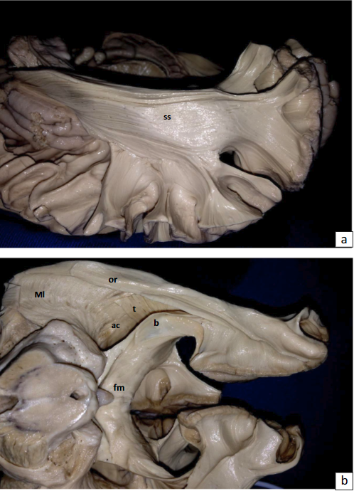 同侧纵裂经楔前叶入路的显微解剖及临床应用