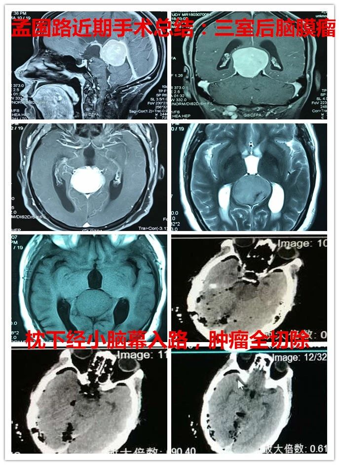 三脑室肿瘤图片