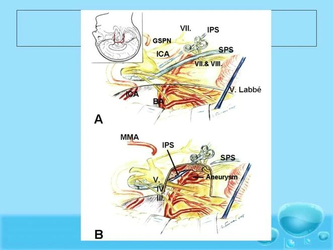 耳前颞下入路改良岩前入路病例脑干海绵状血管畸形