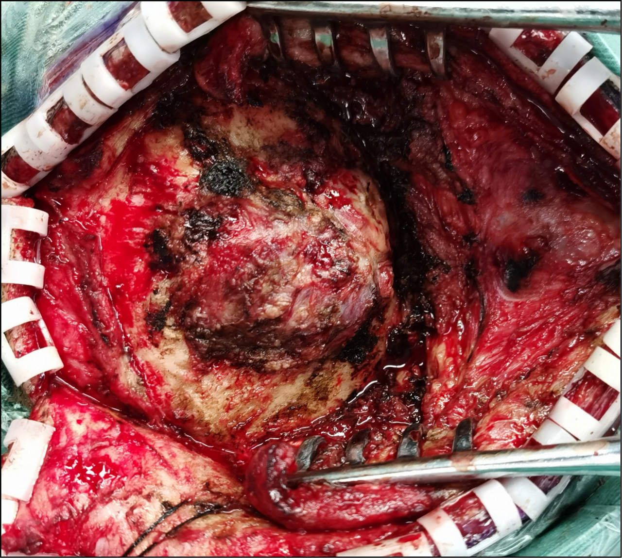 切除突出于颅外的肿瘤后分块切除颅内肿瘤,左侧横窦及窦汇被肿瘤侵犯