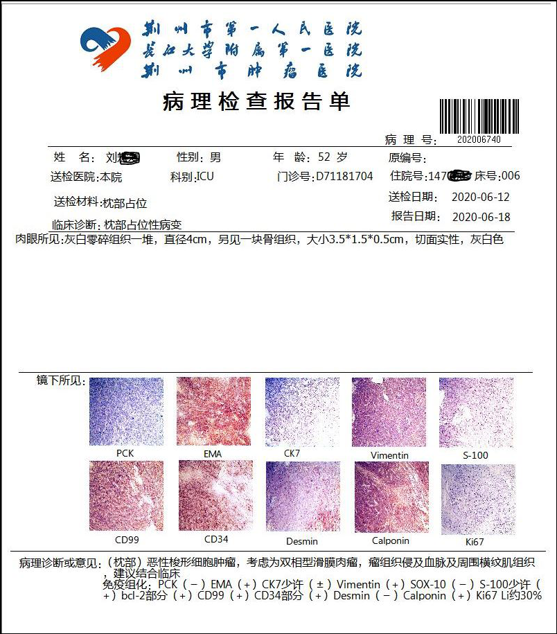 姚远副主任医师:原发后颅窝滑膜肉瘤1例病例分享