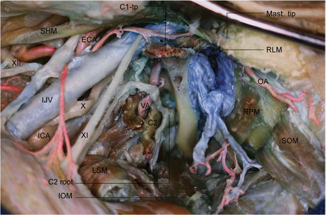 采用内镜辅助显微镜技术通过前外侧交替经髁和斜坡入路的解剖研究