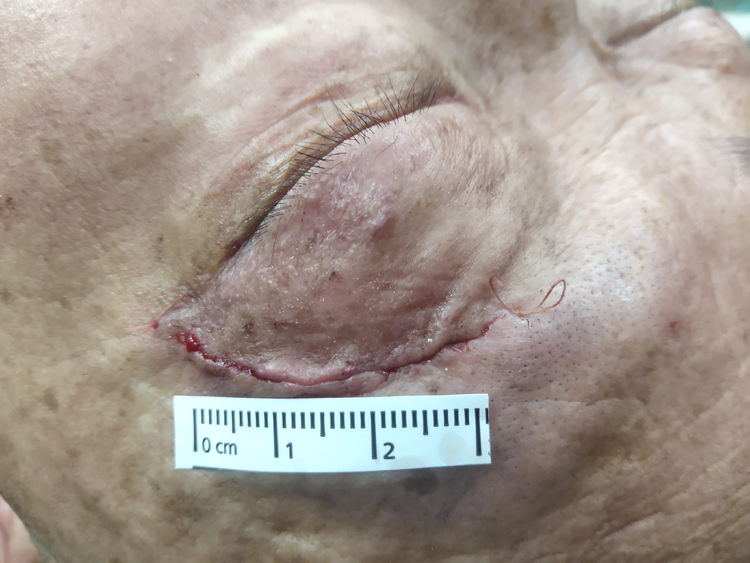 眼眶炎性假瘤手术图片图片