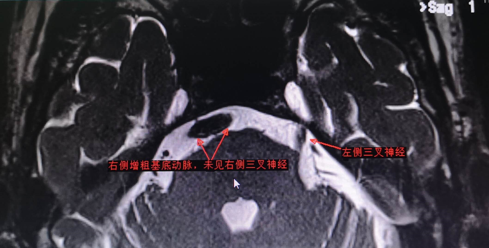 毛建辉主任医师多种因素导致三叉神经痛手术体会