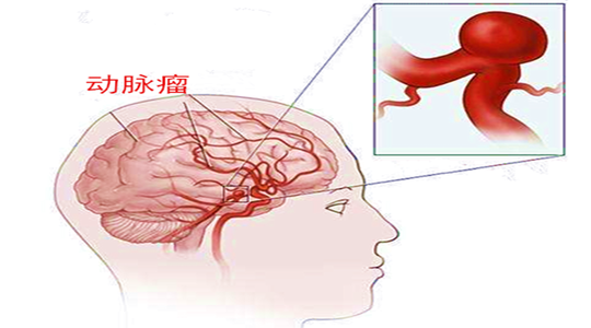 患了動脈瘤應該如何辦