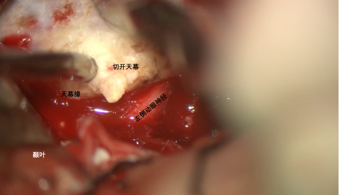 蝶骨嵴内侧脑膜瘤两例