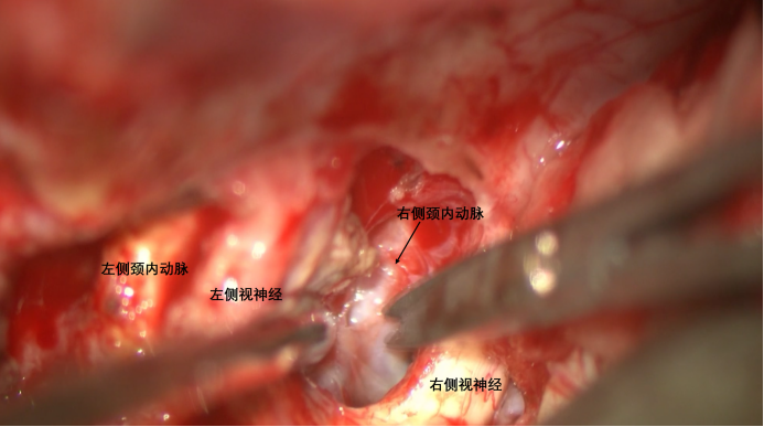 蝶骨嵴内侧脑膜瘤两例761.png