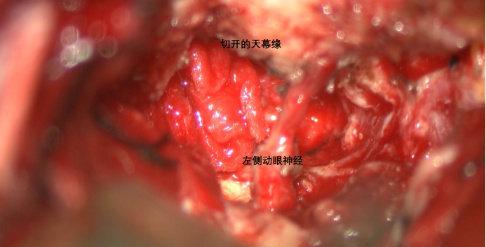 蝶骨嵴内侧脑膜瘤两例823.png