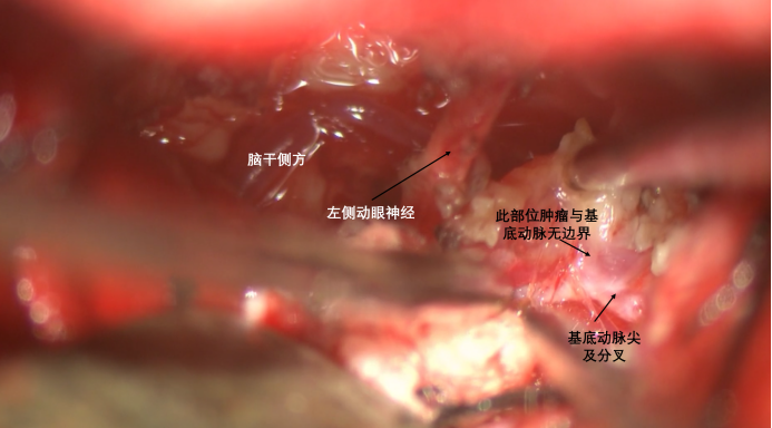蝶骨嵴内侧脑膜瘤两例842.png
