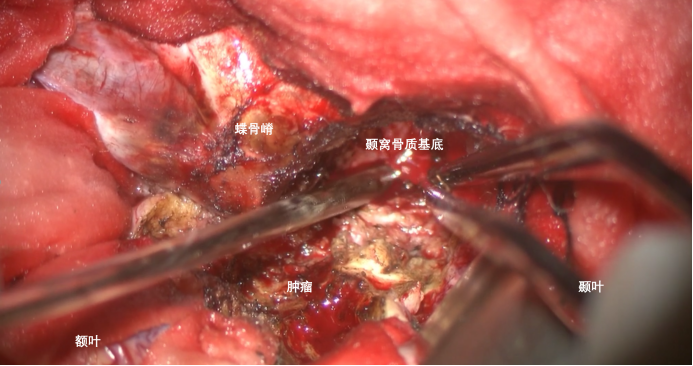 蝶骨嵴内侧脑膜瘤两例1371.png