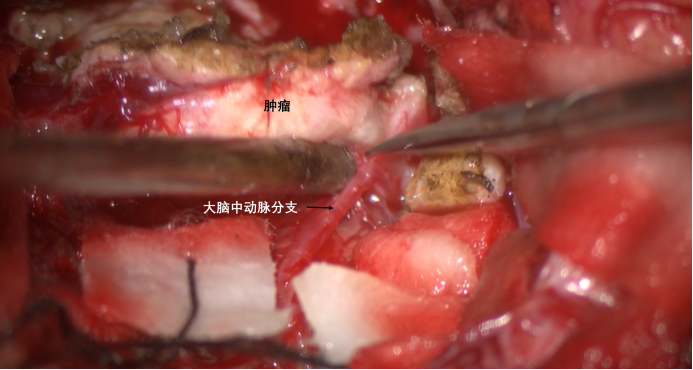 蝶骨嵴内侧脑膜瘤两例1499.png