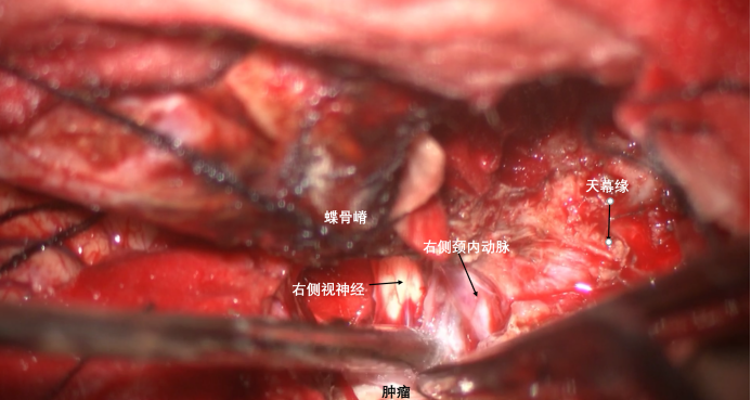 蝶骨嵴内侧脑膜瘤两例1596.png