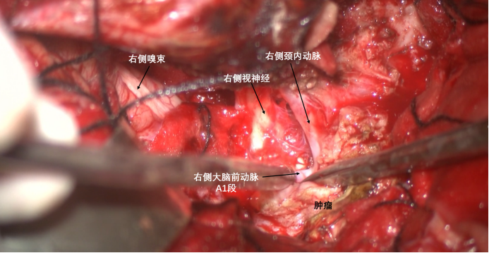 蝶骨嵴内侧脑膜瘤两例1655.png