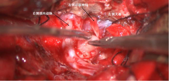 蝶骨嵴内侧脑膜瘤两例1833.png