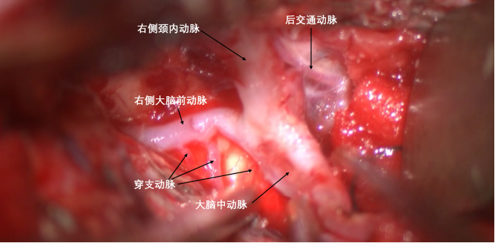 蝶骨嵴内侧脑膜瘤两例1902.png