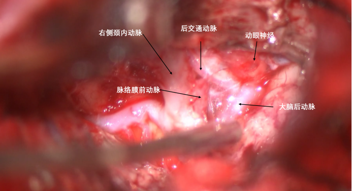 蝶骨嵴内侧脑膜瘤两例1904.png