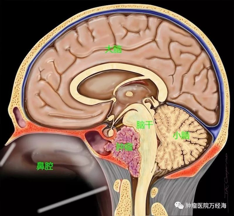 颅底是一层特殊结构,向上托起颅腔里的脑组织,向下分隔眼眶,鼻窦鼻咽
