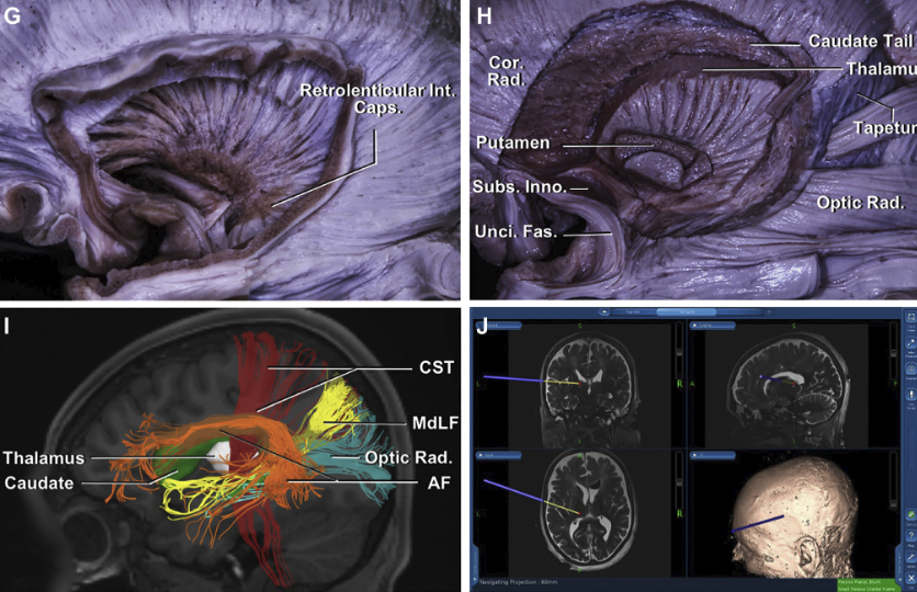 丘腦及其白質纖維束的解剖以及手術入路