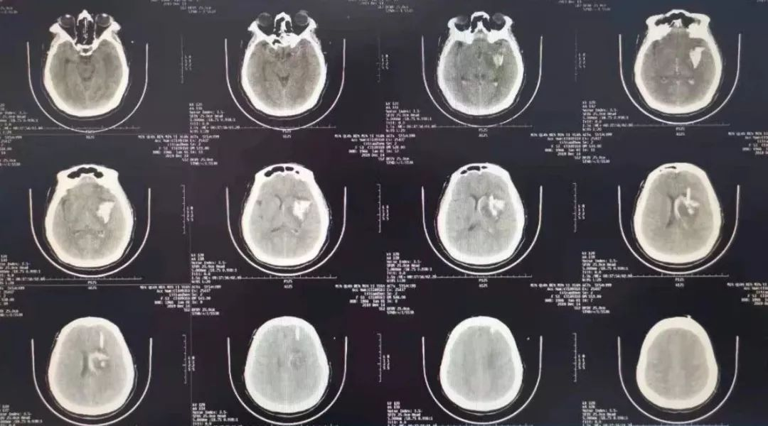 拔管前的ct拔管后的复查ct患者住院期间,随着颅内血肿量的减少,意识