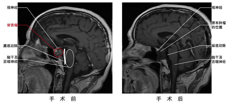 脊索瘤图片及讲解图片