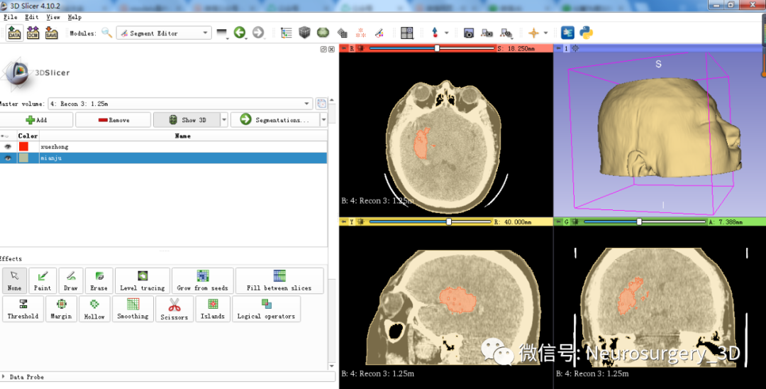 应用3d Slicer设计脑出血3d手术穿刺导板（续） 脑医汇 神外资讯 神介资讯 5986