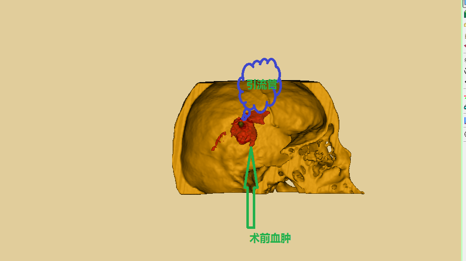 3d下加装延长导管的丘脑出血微创手术治疗