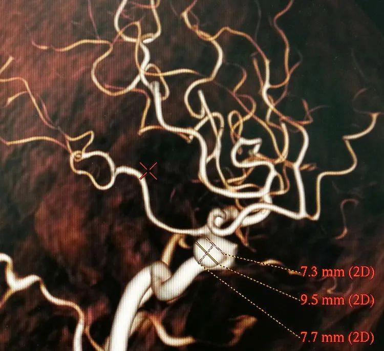 颅内动脉瘤栓塞时弹簧圈的选择第五回中型动脉瘤