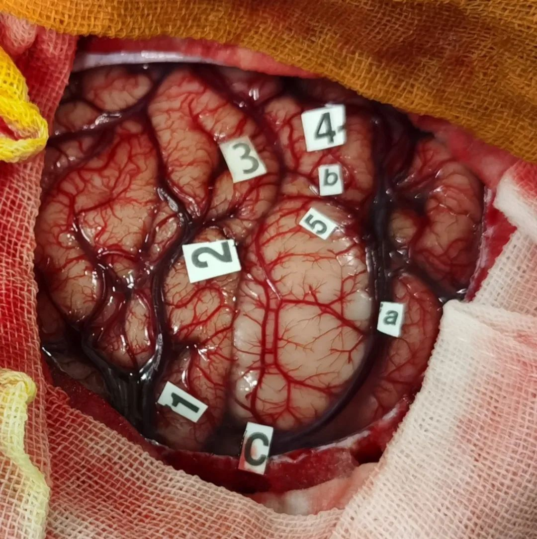 脑皮质切除术图片