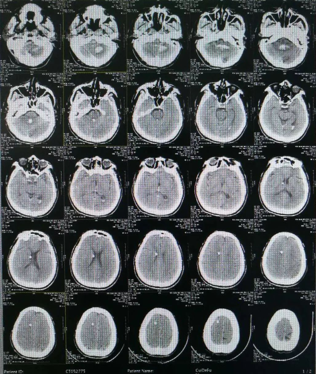 脑出血的ct表现图片