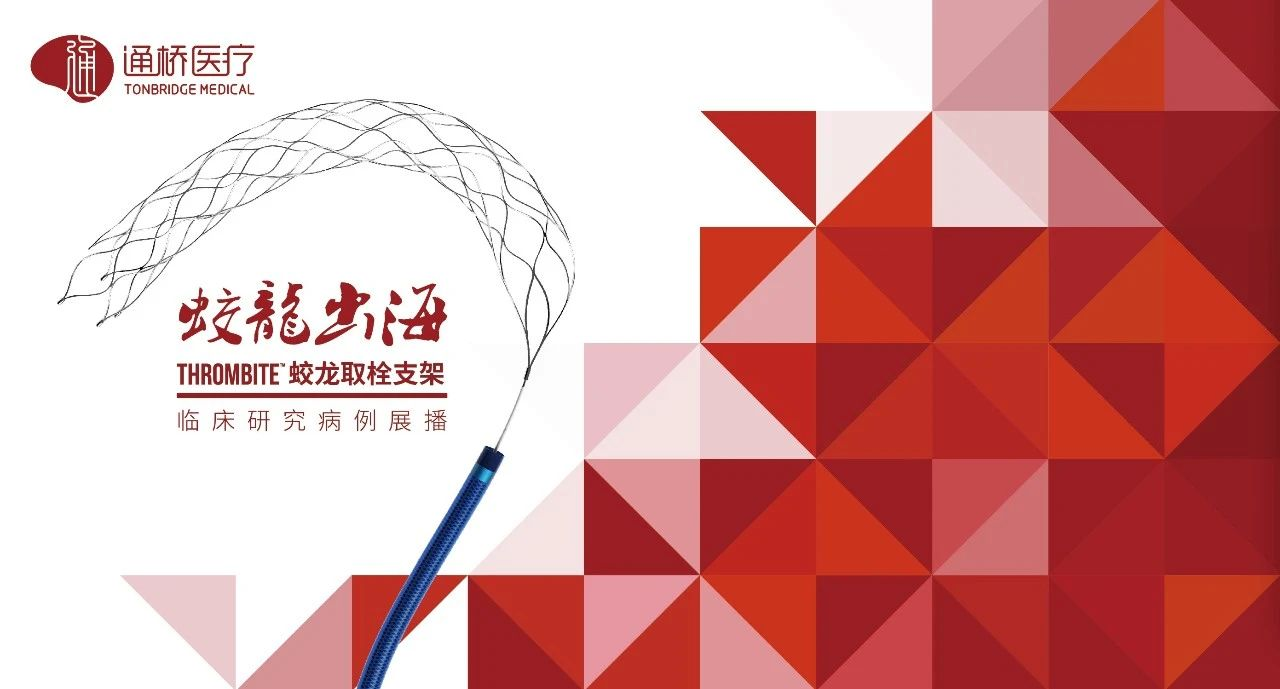 【通桥·蛟龙出海】右侧颈内动脉闭塞双支架串联技术取栓一例