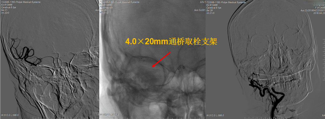 【通桥·蛟龙出海】右侧颈内动脉闭塞双支架串联技术取栓一例 