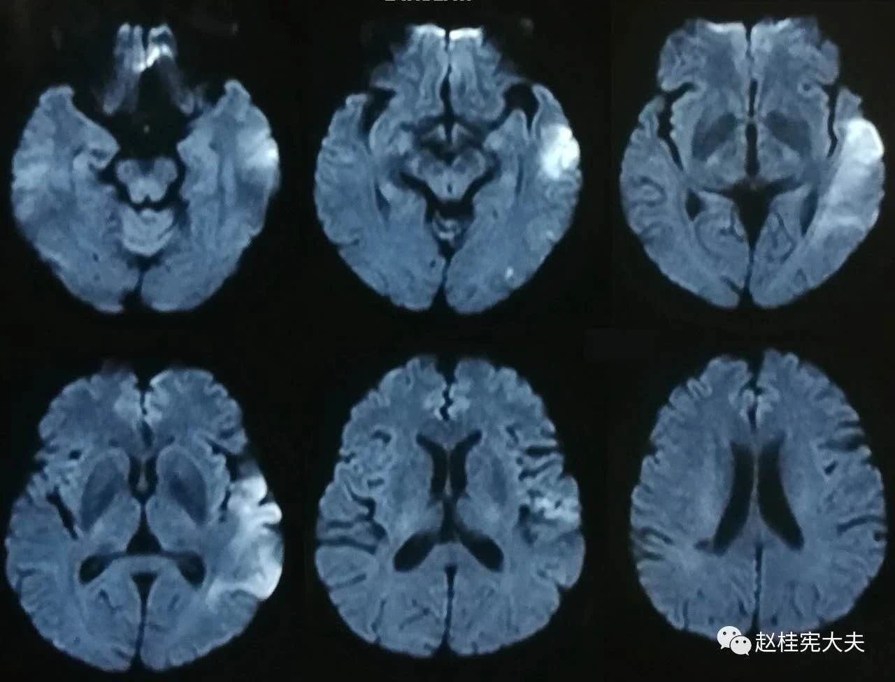 赵桂宪博士脑梗脑炎原来是trolard和labbe皮层静脉梗塞