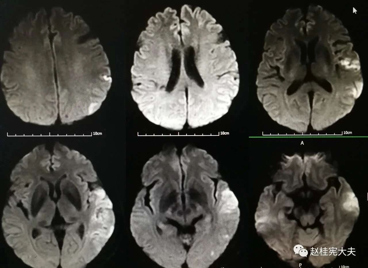 赵桂宪博士脑梗脑炎原来是trolard和labbe皮层静脉梗塞