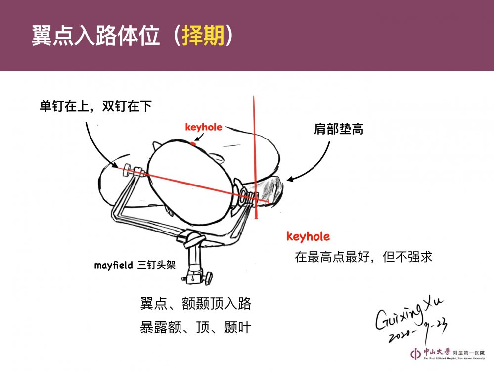 10.9基于“可重复”技能的翼点开颅（手绘数字化版）_01.jpg
