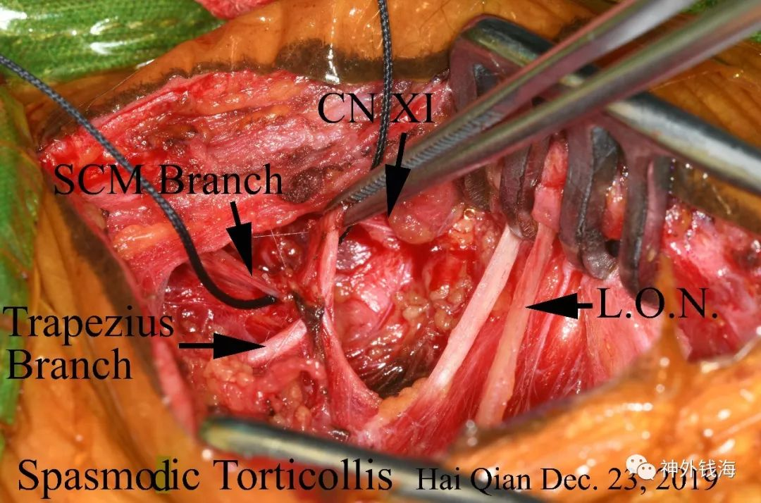 痉挛性斜颈神经外科手术解决