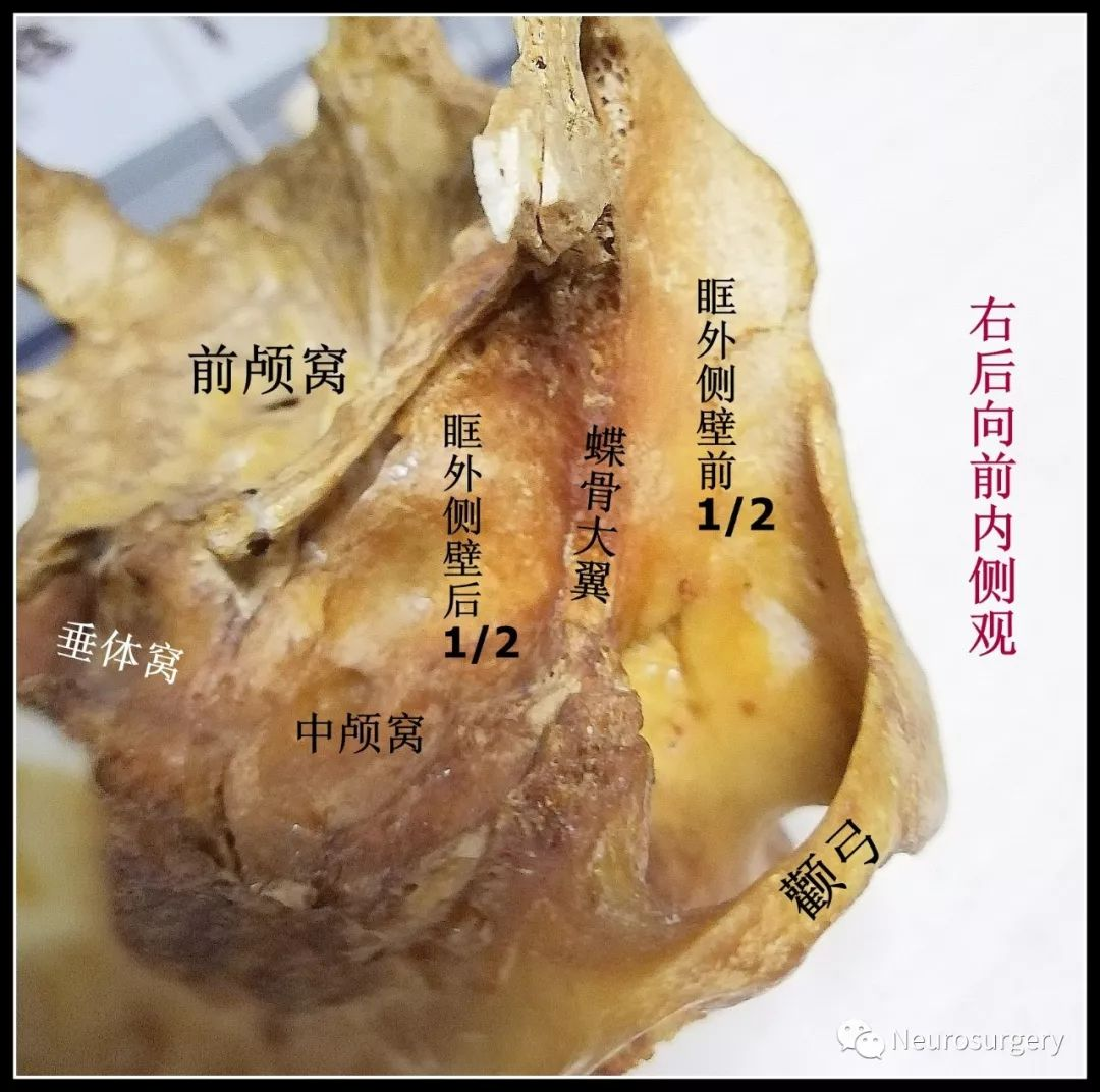 从解剖角度详解翼点入路的头位摆放