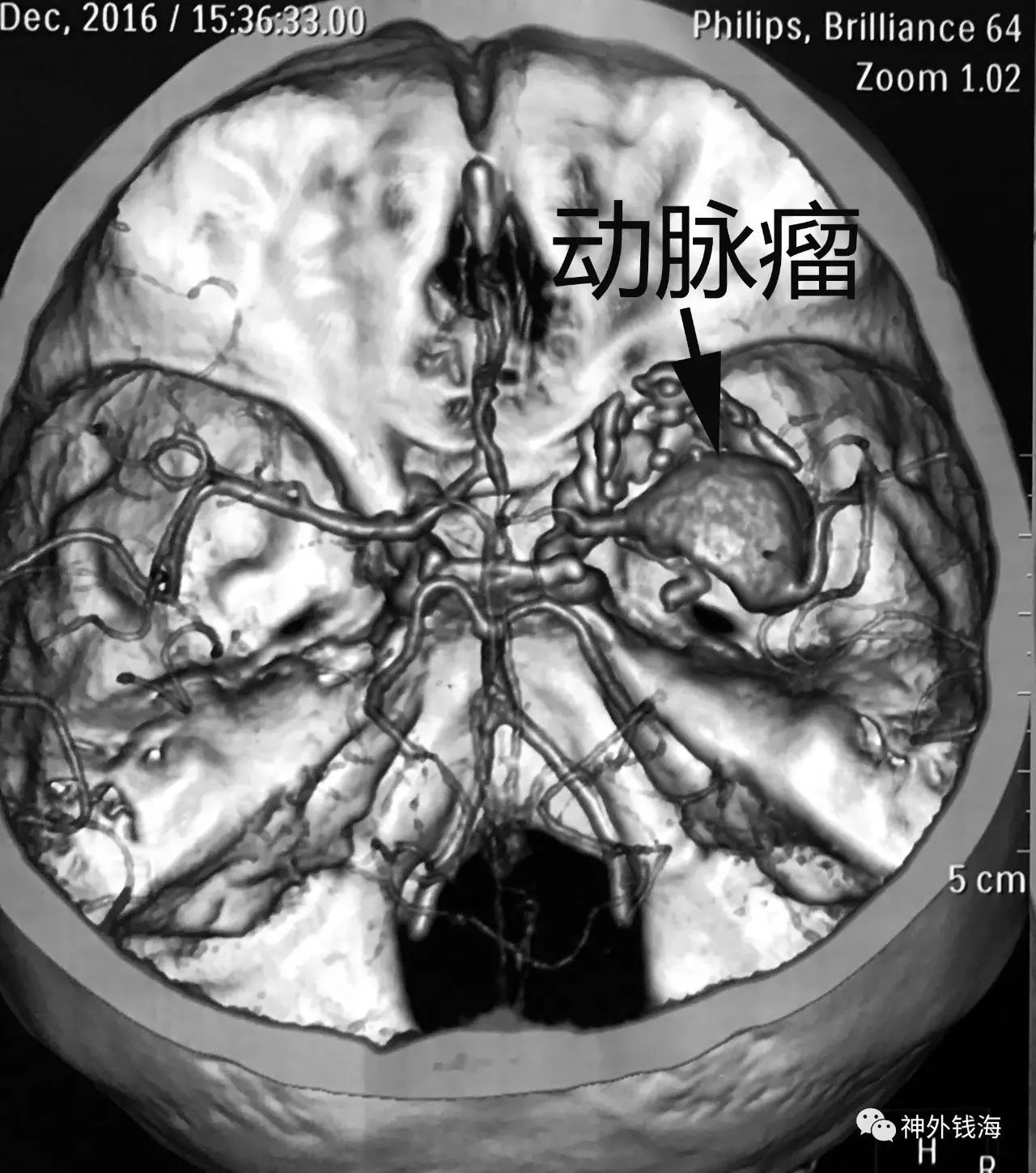 多图｜颅内动脉瘤的影像学诊断