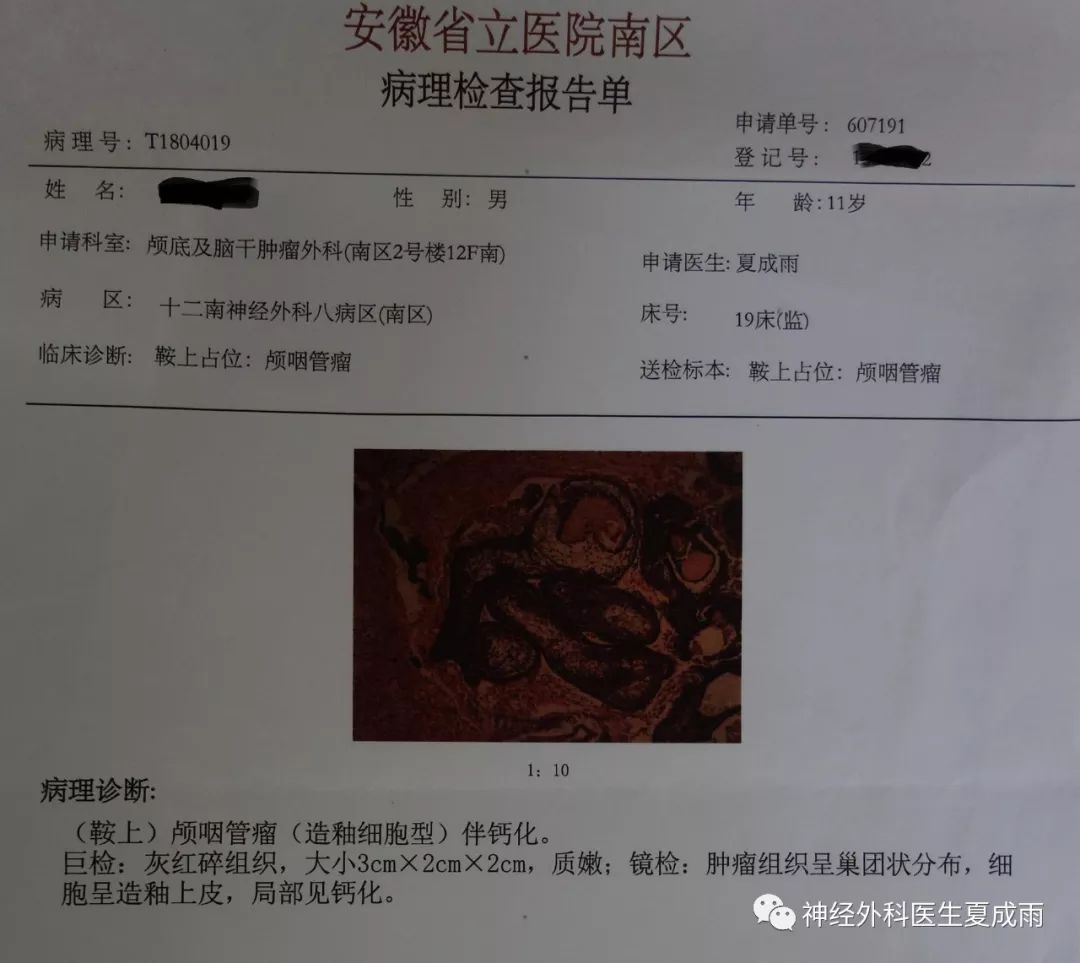 无牵开器前纵裂入路切除钙化显著的颅咽管瘤