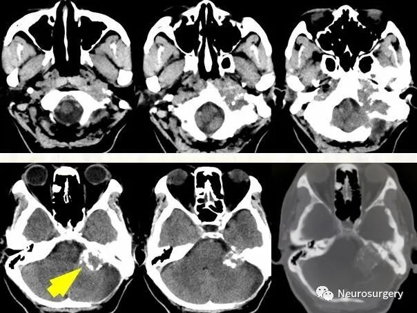 远外侧入路切除颈静脉孔区肿瘤