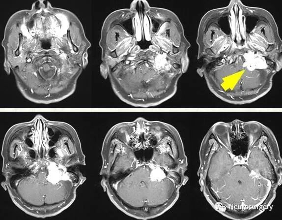 远外侧入路切除颈静脉孔区肿瘤