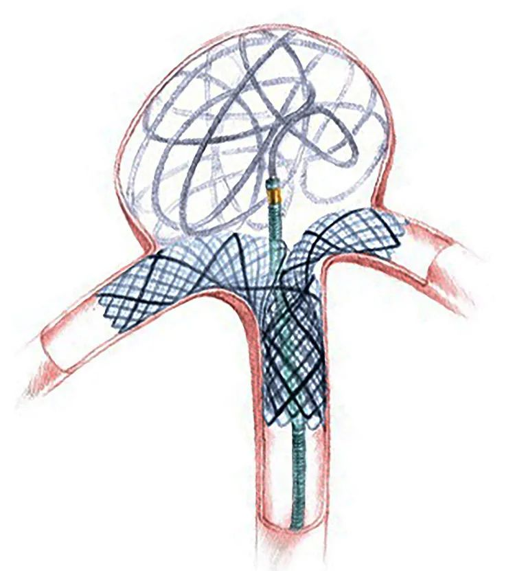 颅内动脉瘤栓塞时弹簧圈的选择第三十五回铆钉技术续