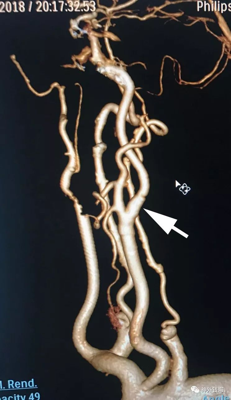 一侧颈动脉闭塞,一侧中度狭窄的cea