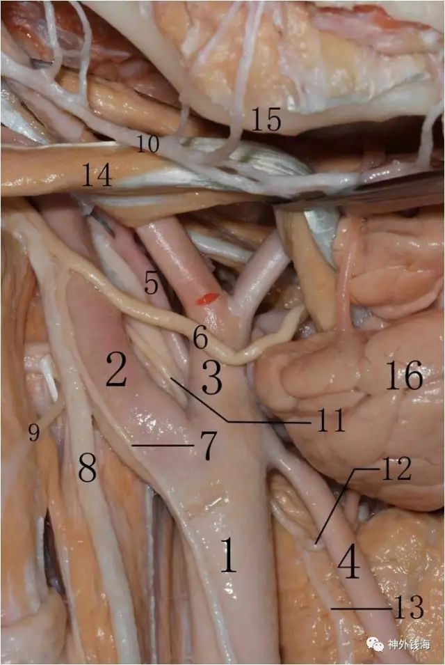 我們辨認一下圖中結構:1.cca 2.ica 3.eca 4.sta 5.咽升動脈 6.