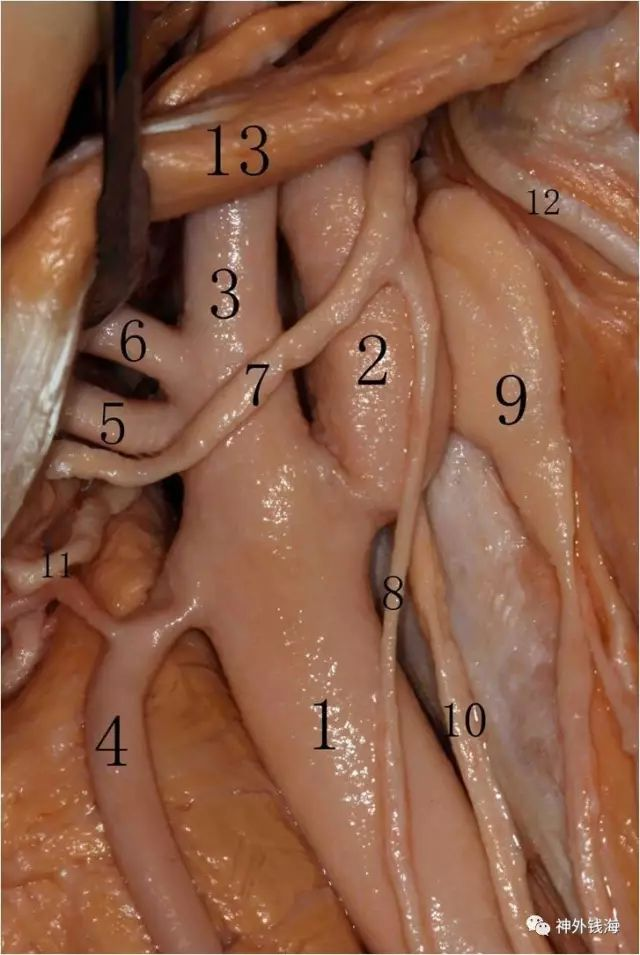 颈动脉内膜剥脱术连载7