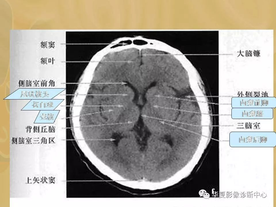 脑左侧基底节部位图片图片