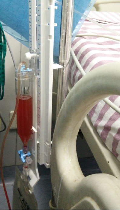 术后8天血性脑脊液(sah)颅内感染?