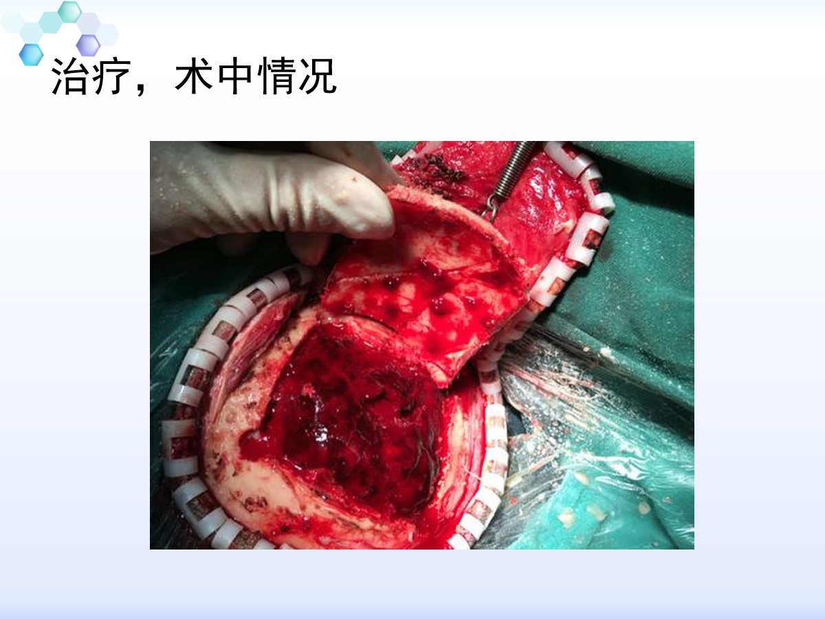 一例创伤性硬膜外血肿手术病例分享